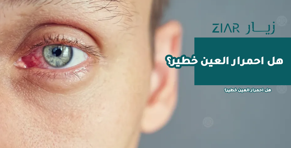 هل احمرار العين خطير؟