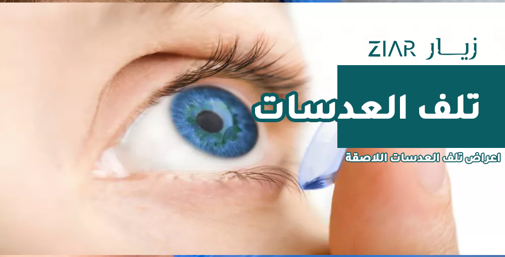 اعراض تلف العدسات اللاصقة