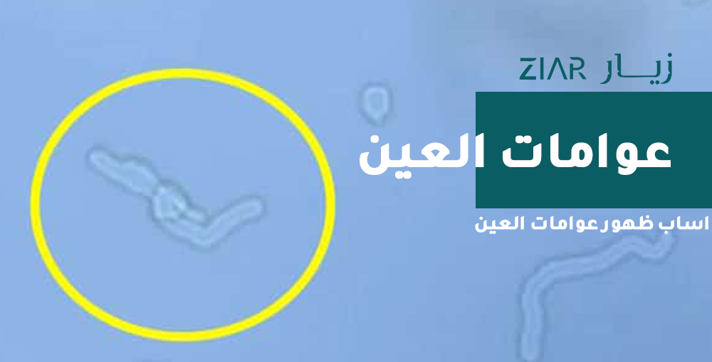 اسباب ظهور عوامات العين وكيفية التخلص منها