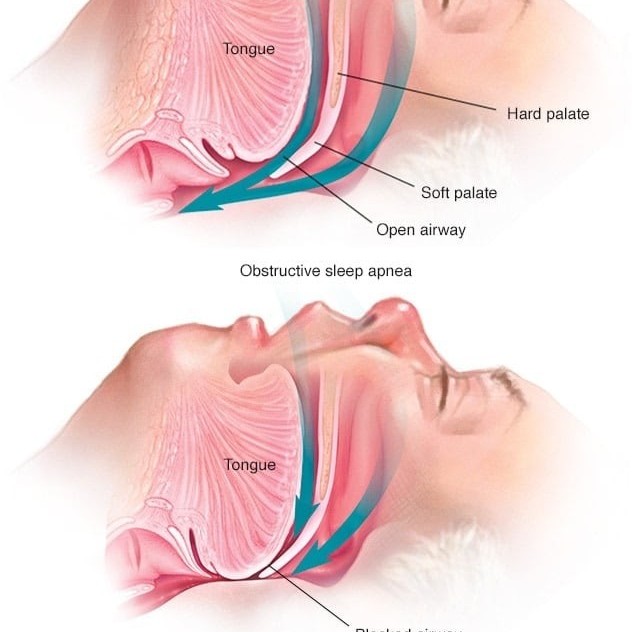 ماهو انقطاع النفس اثناء النوم ؟