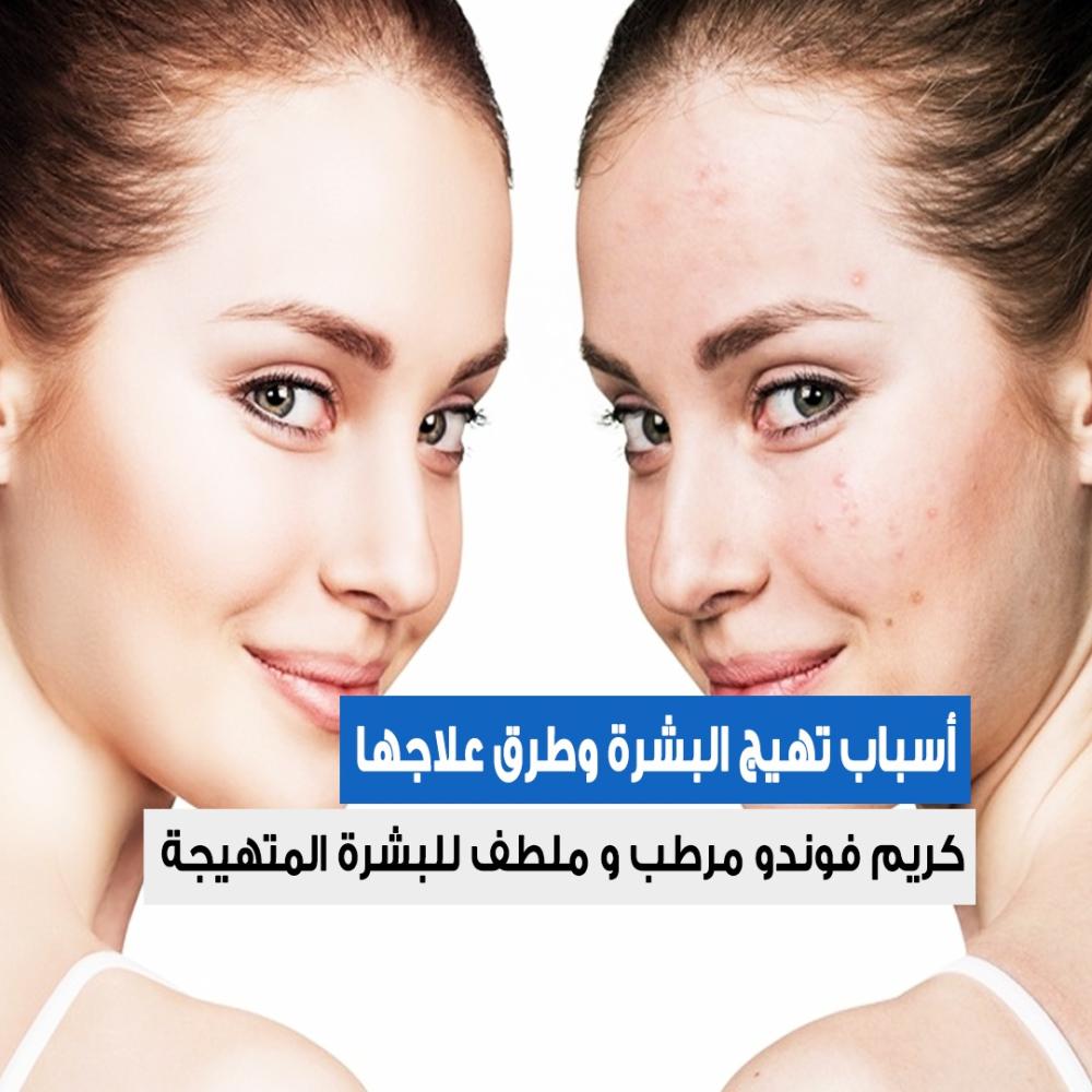 أسباب تهيج البشرة وطرق علاجها .. وتجربتي لإستخدام كريم فوندو السحري