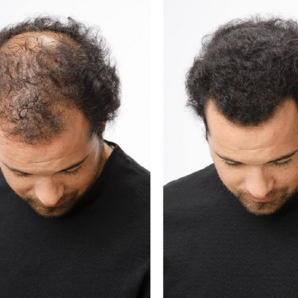 أسباب تساقط الشعر وطريقة العلاج
