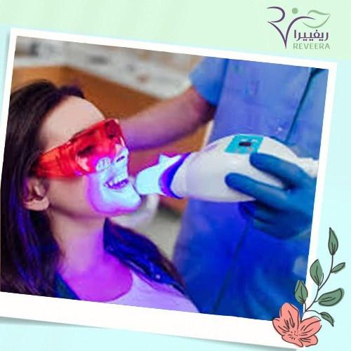 تبييض اسنان