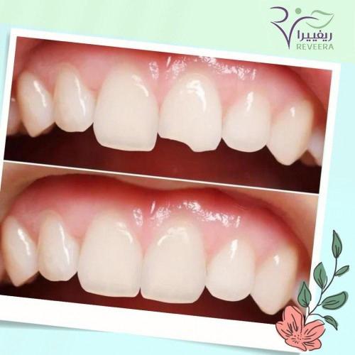 حشوة اسنان2