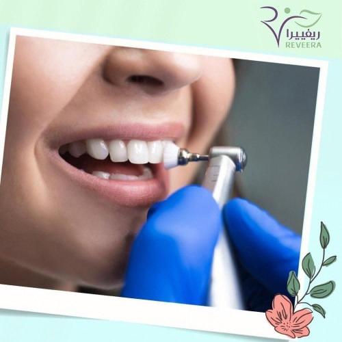 تنظيف وتلميع الاسنان وازالة الجير