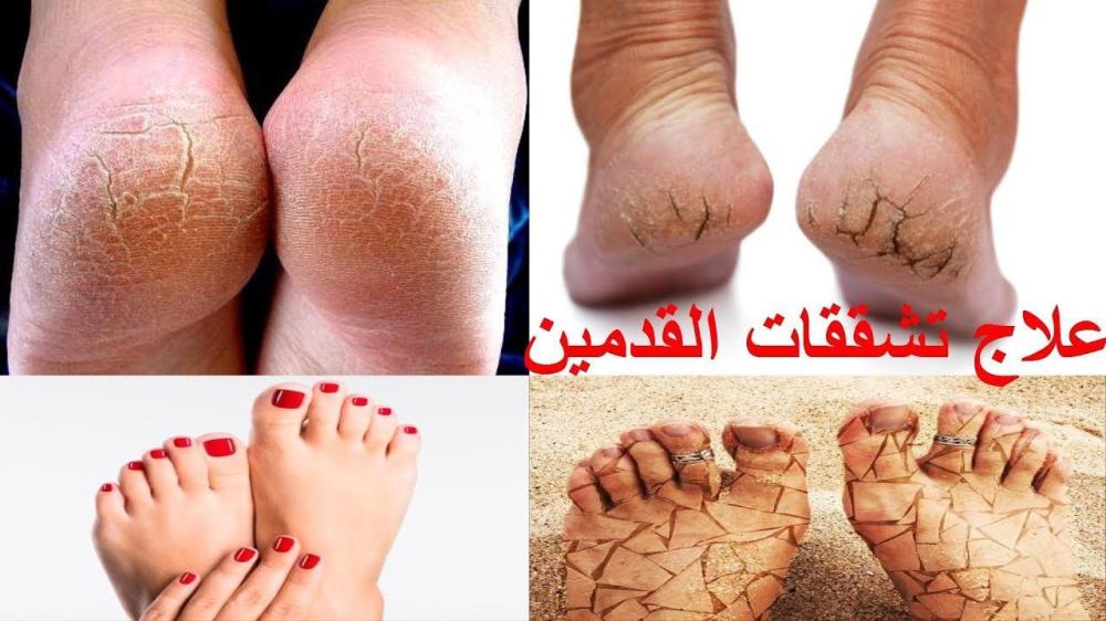أسباب تشقق القدمين عند النساء