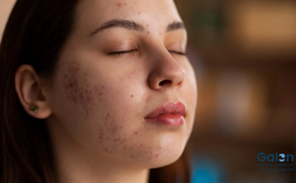 إزالة البقع السوداء من الوجه بالليزر