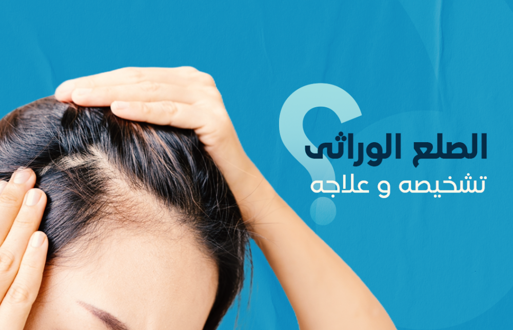 الصلع الوراثي وتشخيصه وعلاجه