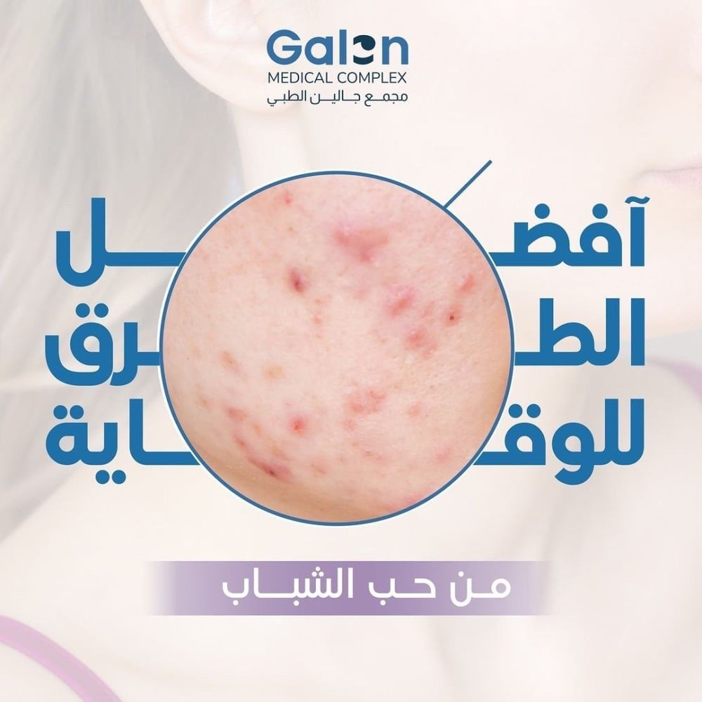 أعراض حب الشباب وأفضل طرق للوقاية منه