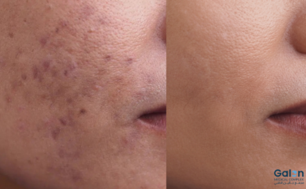 علاج التصبغات في الوجه