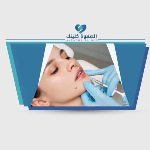 1 مل فيلر +ابرة نضارة