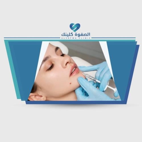3 مل فيلر