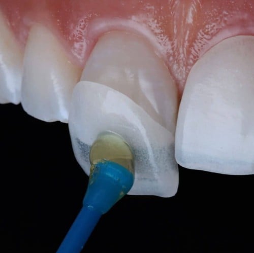 تركيب عدسات الاسنان عدسات فينير للسن الواحد