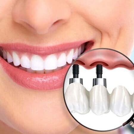 زراعة الاسنان الفورية الامريكية للزرعة الواحدة