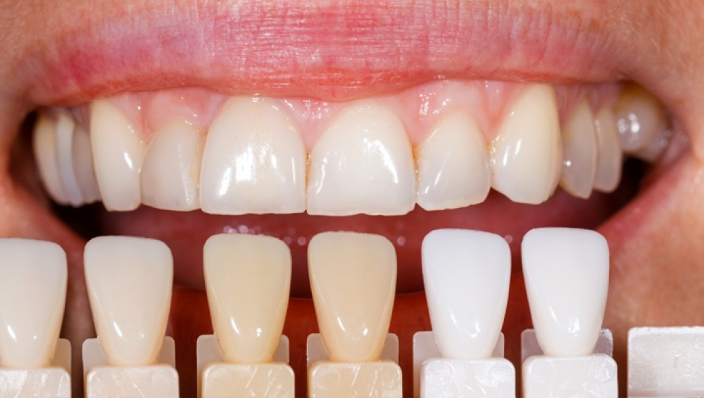 الحشوات التجميلية ابتسامة أكثر إشراقًا