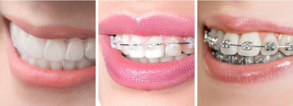 هل التقويم الشفاف أفضل من المعدني؟ مقارنة كاملة