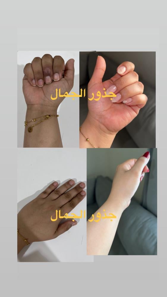 مجموعه ازاله التصبغات ( مصرحه من هيئه الغذاء والدواء