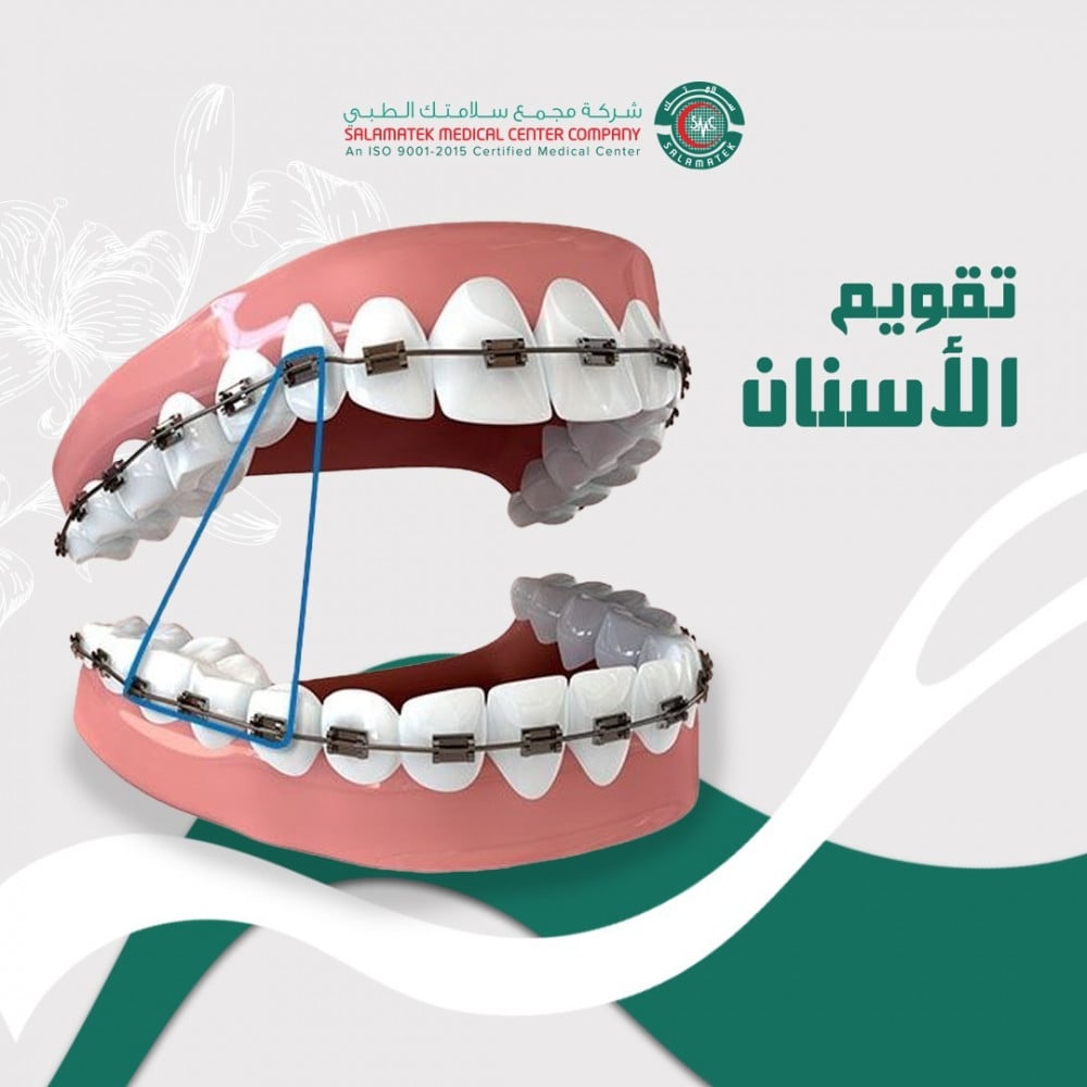 تقويم الأسنان كاملا نقدا  (2023110)