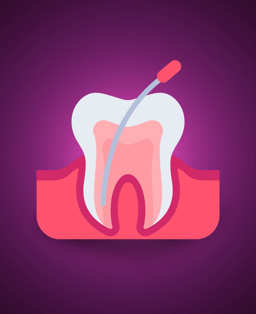 سحب عصب ضرس مع وتد دعامي