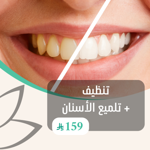 تنظيف + تلميع الأسنان