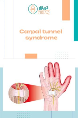 Carpal tunnel syndrome