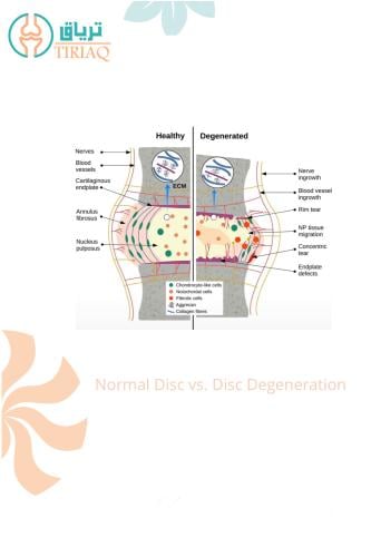 Normal Disc vs. Disc Degeneration