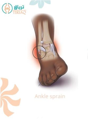 Ankle sprain