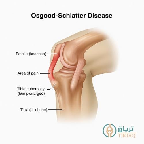 Osgood-Schlatter Disease