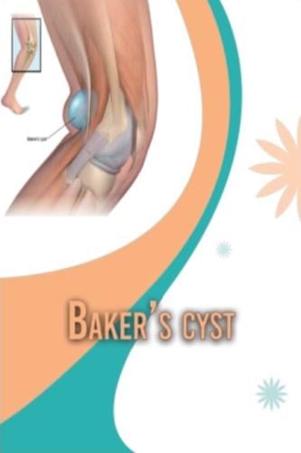 Baker's Cyst