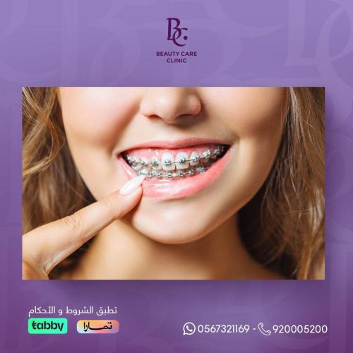 تقويم الاسنان المعدني يبدأ من