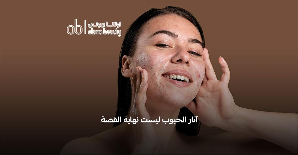 علاج آثار حب الشباب