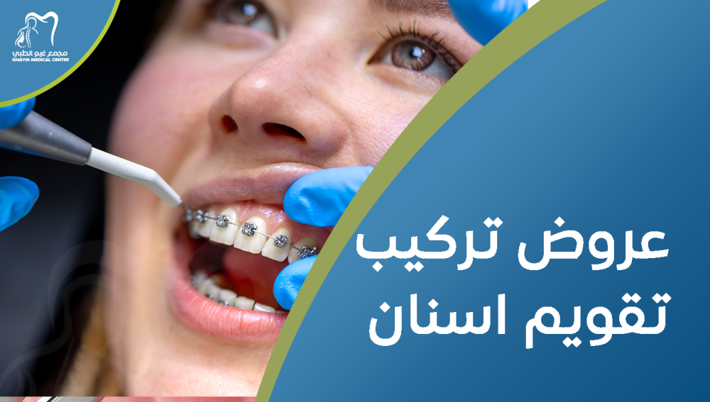 عروض تركيب تقويم اسنان