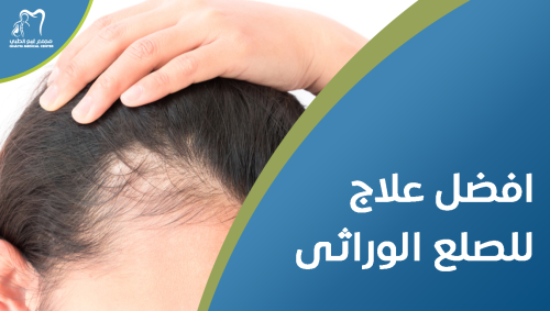 افضل علاج للصلع الوراثى , الحلول الأكثر فعالية