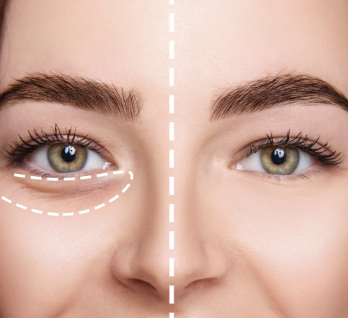 جلسة توسيال حول العين