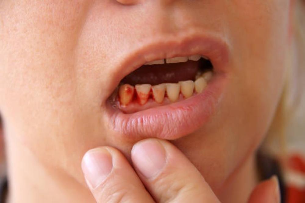 علاج نزيف اللثه