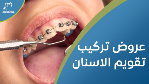 عروض تركيب تقويم الاسنان بأفضل الأسعار