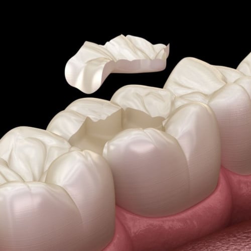 الحشوات التجميلية البسيطة
