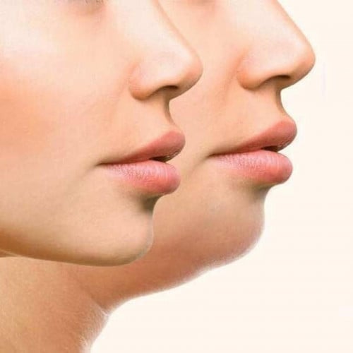 جلسة الهايفو للذقن المزدوج