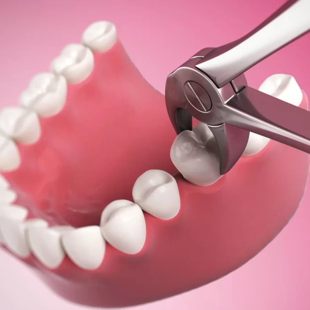 Extraction of Impacted (Remainig) Roots / Tooth