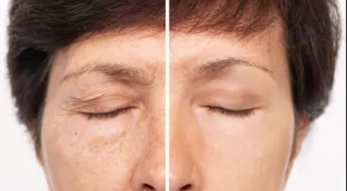 بكج الشد المائي