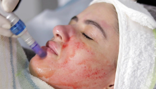 Dermapen (6 sessions)