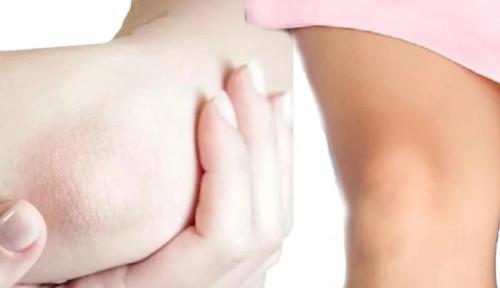 HydraFacial for hands, elbows, knees, and underarms