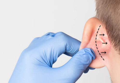 Ear pulling - Dr. Mohamed El Nahas