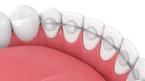 مثبت دائم لساني