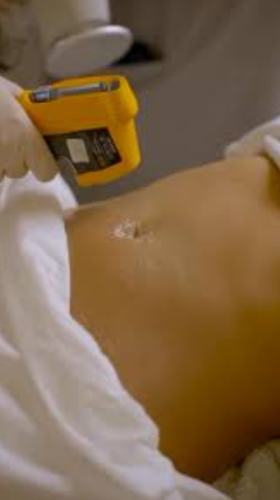 صقل القوام غير الجراحي لليدين بدمج جهازي فينوس ليجسي + إم سكلبت