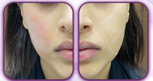 الابره الملكيه