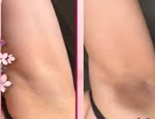 HydraFacial underarm treatment (3 sessions)