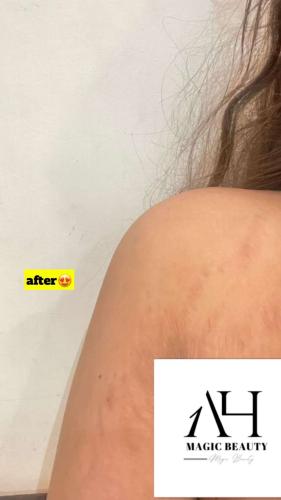 جلسه علاجيه لتشققات الجسم