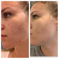 محلول تقشير الوجه ايه اتش ايه 30% من ذا اوردينري 3...