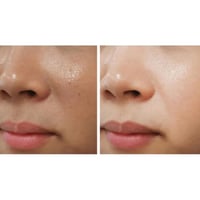 اي سي ام ACM -كريم تفتيح البشرة و إزالة البقع الدا...